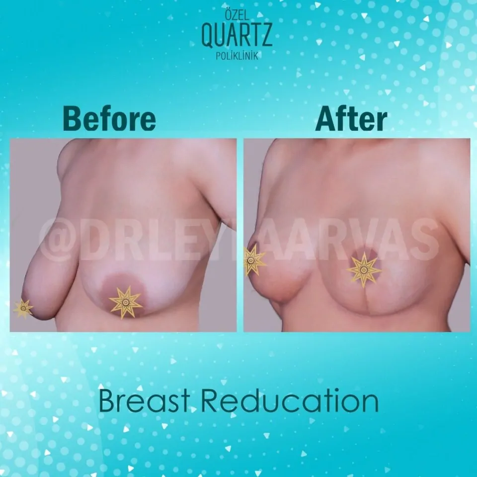 Meme Dikleştirme Estetiği Hakkında Merak Edilenler Quartz Poliklinik görseli Meme Dikleştirme Estetiği Hakkında Merak Edilenler Quartz Poliklinik